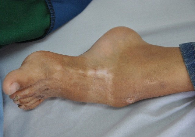 Chân của bé Nguyễn Tác Tuấn bị biến dạng do bệnh Hemophilia và tai nạn